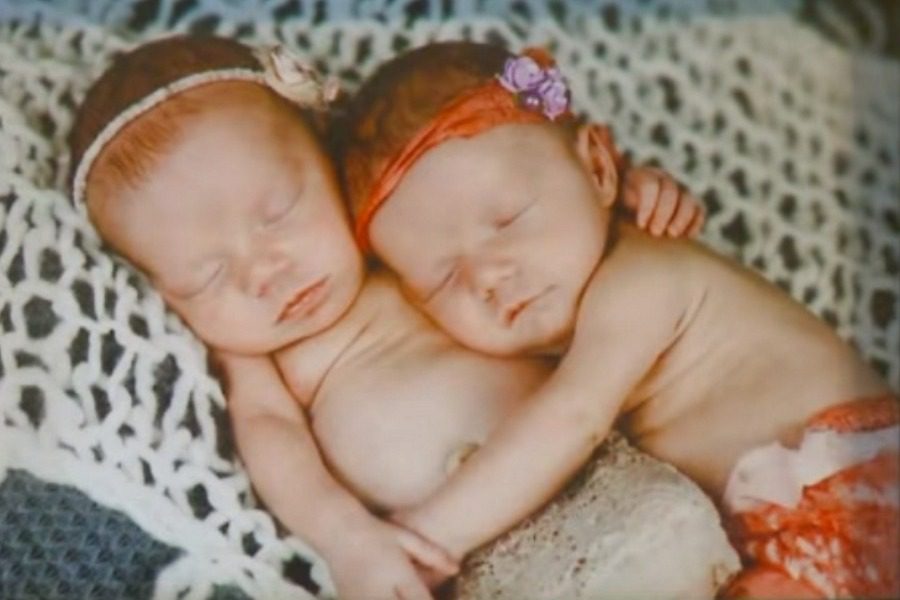 Τα δίδυμα μωρά που κινδύνεψαν στην γέννα και γεννήθηκαν αγκαλιασμένα
