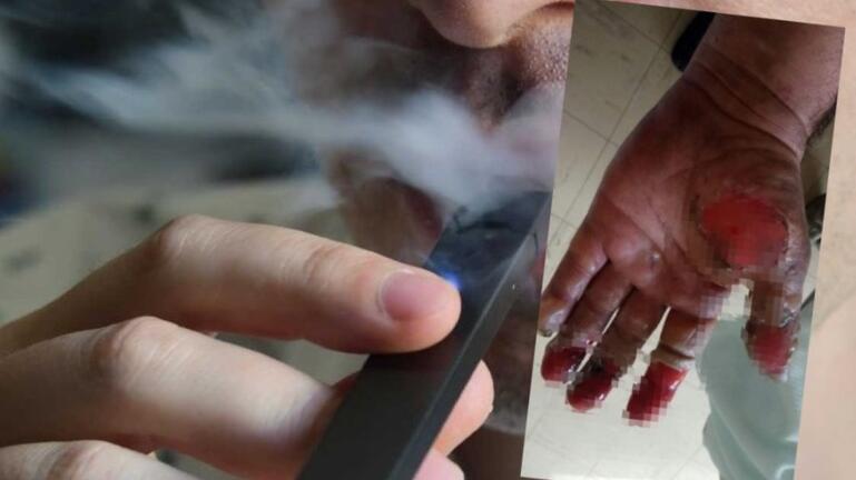 Έκρηξη μπαταρίας ηλεκτρονικού τσιγάρου του προκάλεσε σοβαρά εγκαύματα