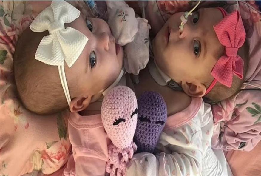 Σιαμαία κοριτσάκια διαχωρίστηκαν μετά από χειρουργείο 10 ωρών