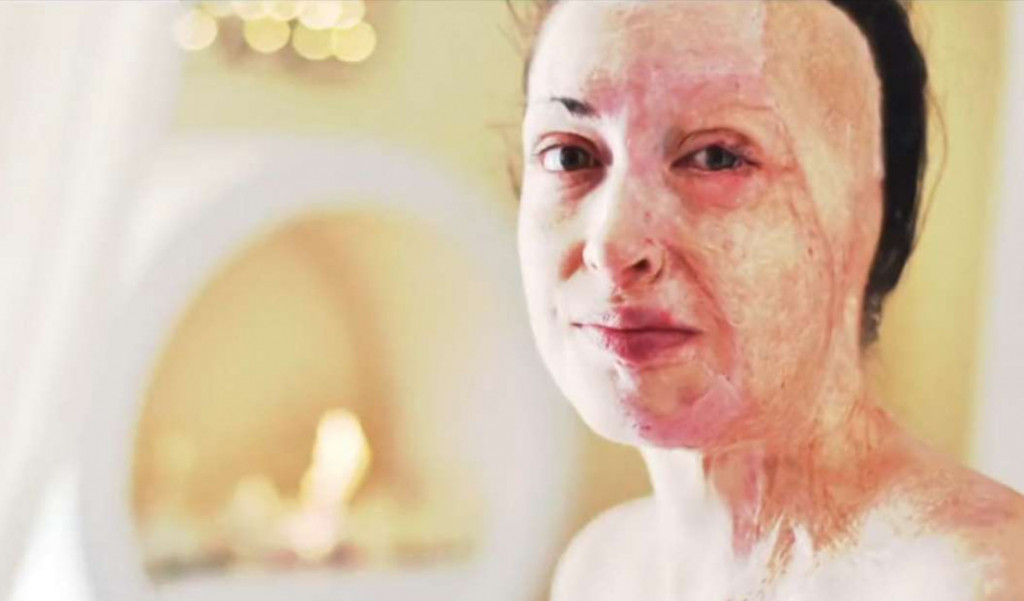 Ιωάννα Παλιοσπύρου: Έδειξε το πρόσωπό της και περιέγραψε τις δραματικές στιγμές της επίθεσης με βιτριόλι