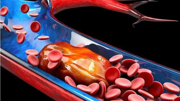 Πώς θα καταλάβετε τη διαφορά μεταξύ μελανιών και θρόμβων αίματος